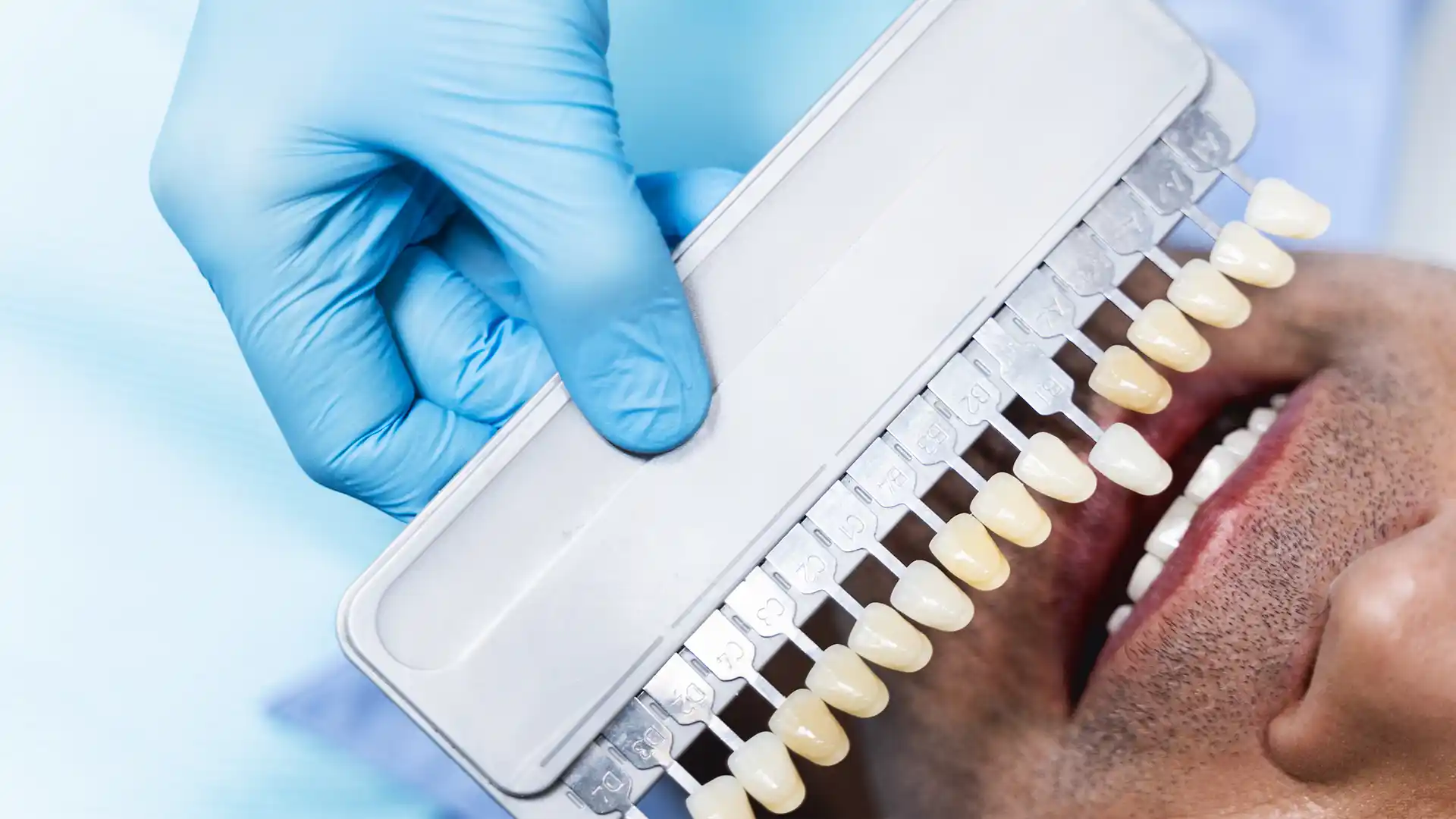  Smile makeover in Turkey 